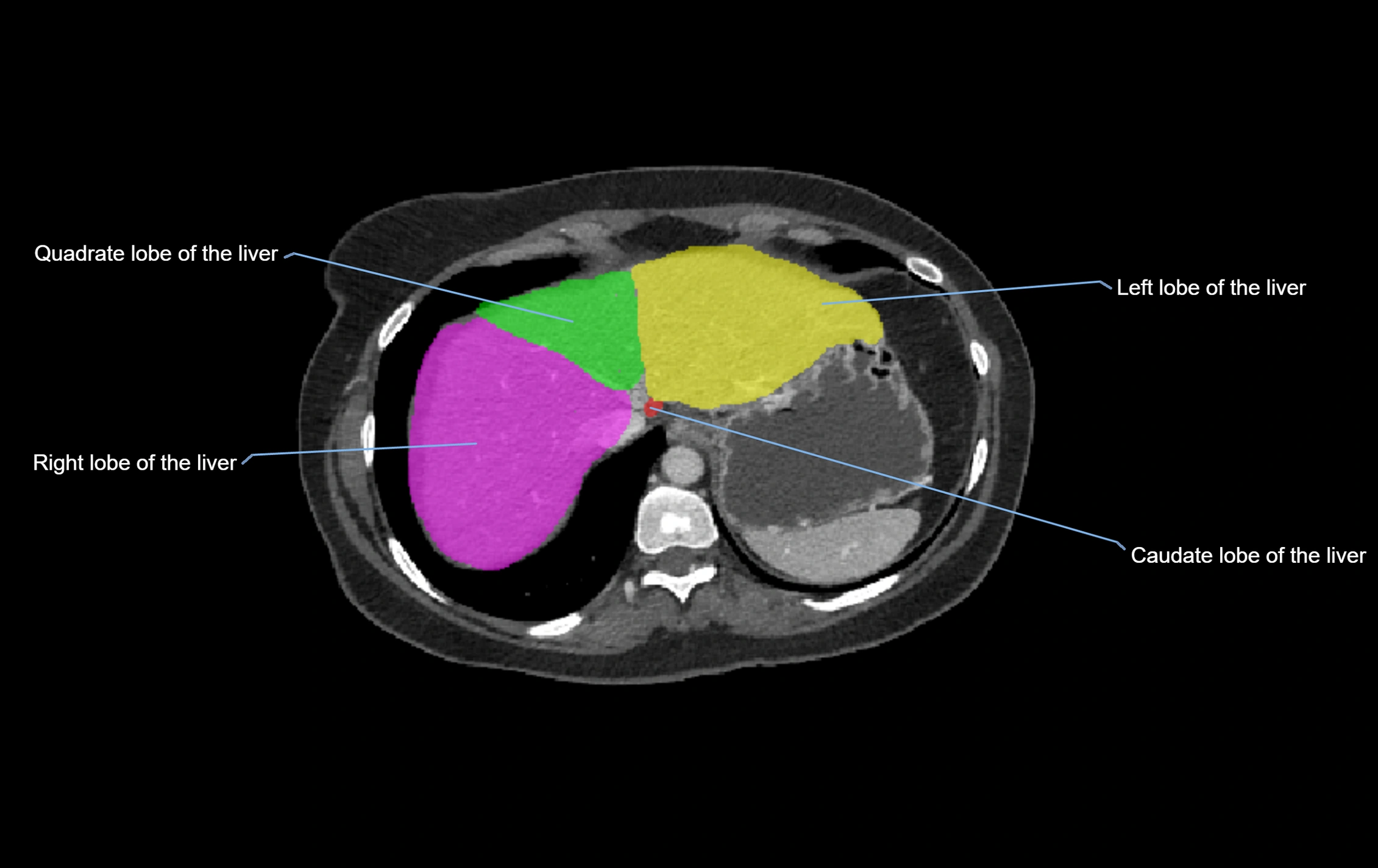 CT lliver lobes axial cross sectional anatomy labelled image -00066.webp